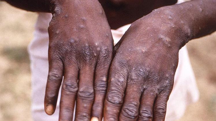I segni della patologia sulle mani di un paziente